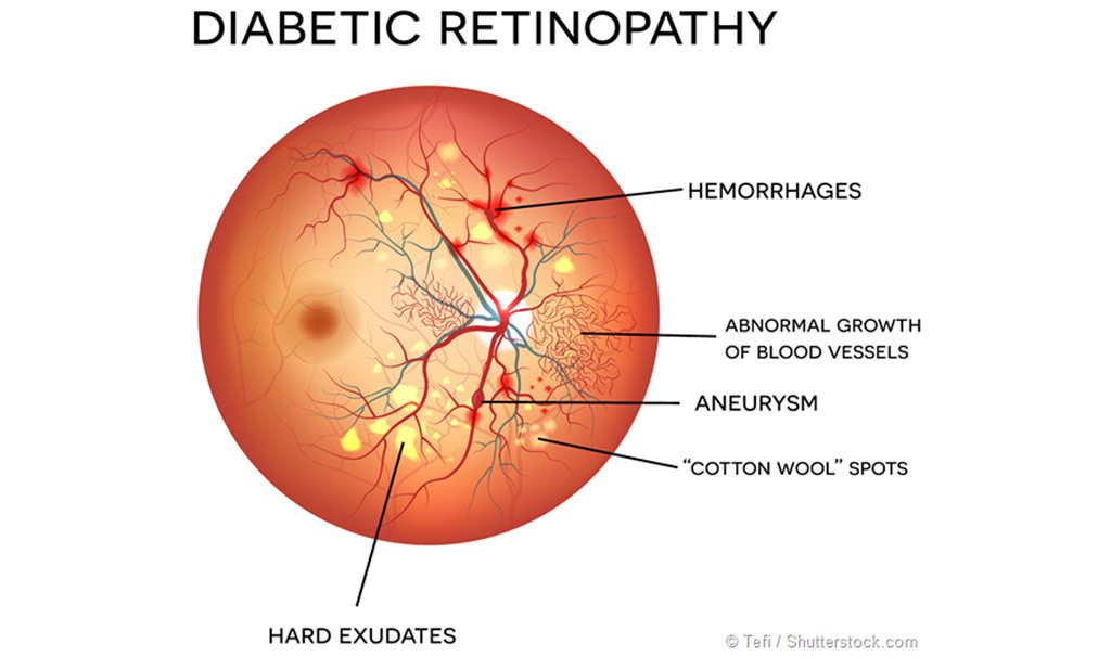 AI-diabetic-retinopathy